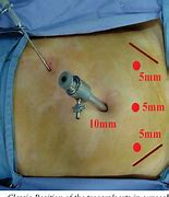 Image result for Ovarian Cyst Removal Surgery Scar