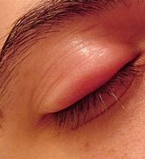 Image result for Woke Up with Swollen Eyelid