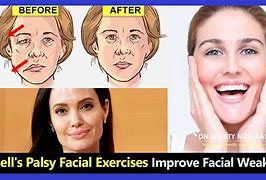 Image result for Bell Palsy Exercises