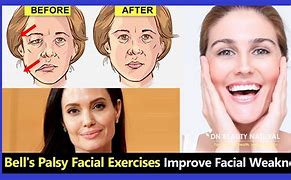 Image result for Bell's Palsy Face Exercises