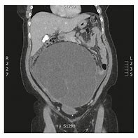 Image result for Ruptured Ovarian Cyst