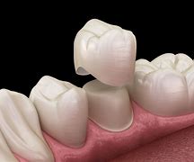 Image result for Dental Crown On Molar