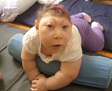 Image result for Baby K Anencephaly