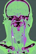 Image result for Abnormal Carotid Ultrasound