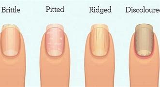 Image result for Warts On Fingers Nails