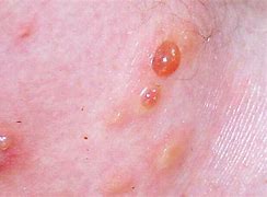 Image result for Mosquito Bites Allergic Reaction