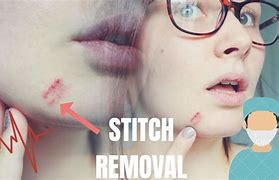 Image result for Mole Removal Stitches