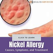 Image result for Nickel Allergy Skin Rash