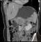 Image result for Spen Pancreas CT