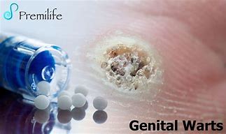 Image result for Genital Wart Removal Home Remedies