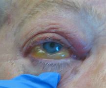Image result for Fungal Eye Infection