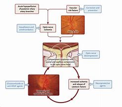 Image result for Ischemic Optic Neuropathy