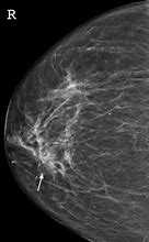 Image result for Spiculated Mass On Mammogram