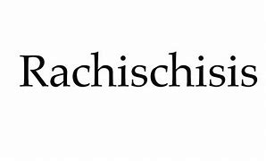 Image result for Rachischisis