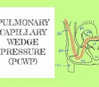 Image result for Pulmonary Wedge Pressure