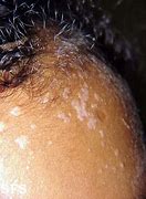 Image result for Skin Warts On Scalp