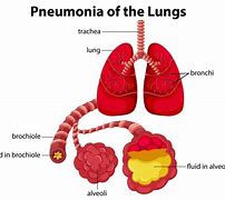 Image result for MRSA Pneumonia