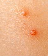Image result for Molluscum Behind Knee in Toddler