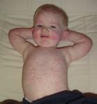 Image result for Fifth Disease Baby