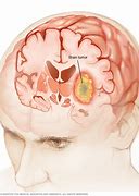 Image result for Meningioma Brain Tumors 1 Cm