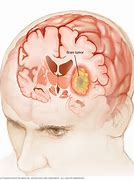 Image result for Brain Tumor Cells