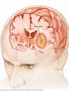 Image result for Brain Tumor Behind Eye