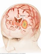 Image result for Benign Brain Tumor