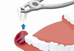 Image result for Wisdom Teeth Anatomy