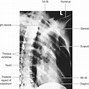 Image result for X Ray Markers