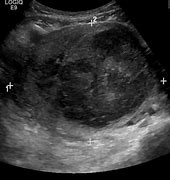 Image result for 9 Centimeter Fibroid
