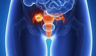 Image result for Ovarian Cancer Tumor Size