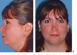 Image result for Failed Rhinoplasty
