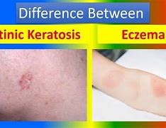 Image result for Actinic Keratosis Nose