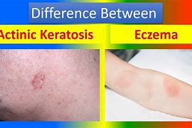 Image result for AK Actinic Keratosis