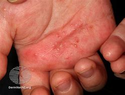 Image result for Scabies Kids