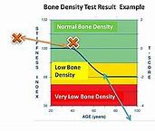 Image result for Osteoporosis Bone Density Chart