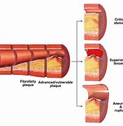 Image result for Atherosclerosis in Hand On XR