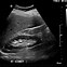 Image result for First-Trimester Ultrasound