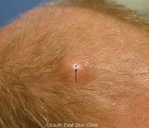 Image result for Sebaceous Cyst On Scalp