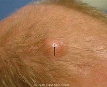 Image result for Sebaceous Cyst On Thigh