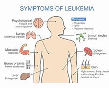 Image result for Acute Lymphoblastic Leukemia Symptoms