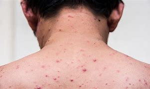 Image result for Chickenpox in Adults