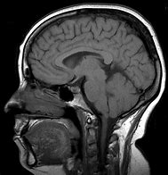 Image result for Tumor On Pituitary Gland