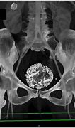 Image result for Partially Calcified Uterine Fibroid