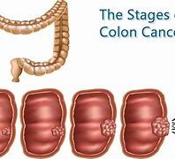 Image result for 5Mm Colon Polyp
