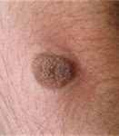 Image result for STD Warts