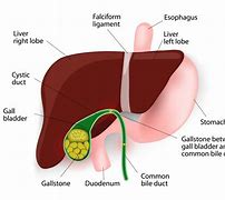 Image result for 2 Cm Gallbladder Stone