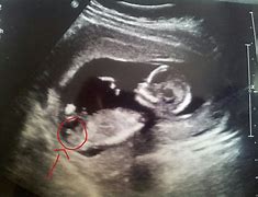 Image result for 13 Week Ultrasound of Boy