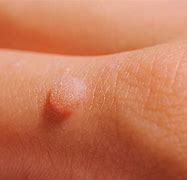 Image result for Different Kinds of Warts