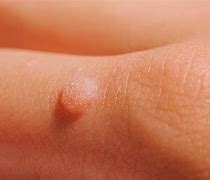 Image result for Plantar Warts Contagious